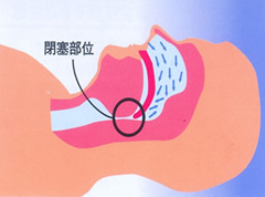 3.睡眠時無呼吸症候群(SAS)になる原因と頻度を観てみましょう